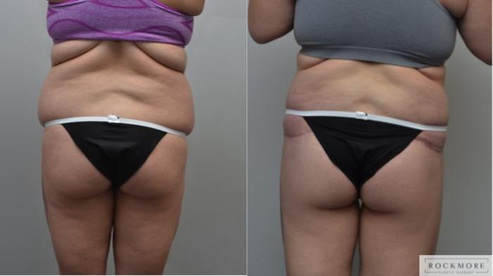 Before & After Body Contouring After Weight Loss Case 278 View #6 View in Albany & Latham, New York