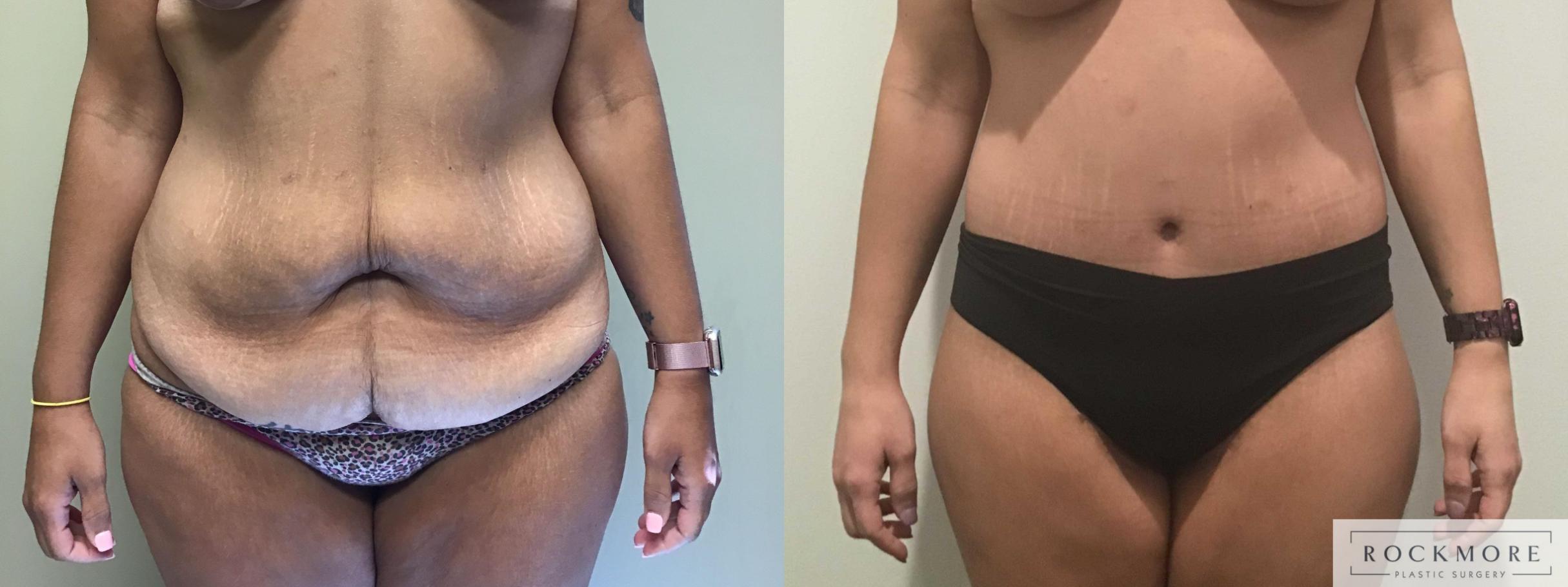 Before & After Body Contouring After Weight Loss Case 330 Front View in Albany & Latham, New York