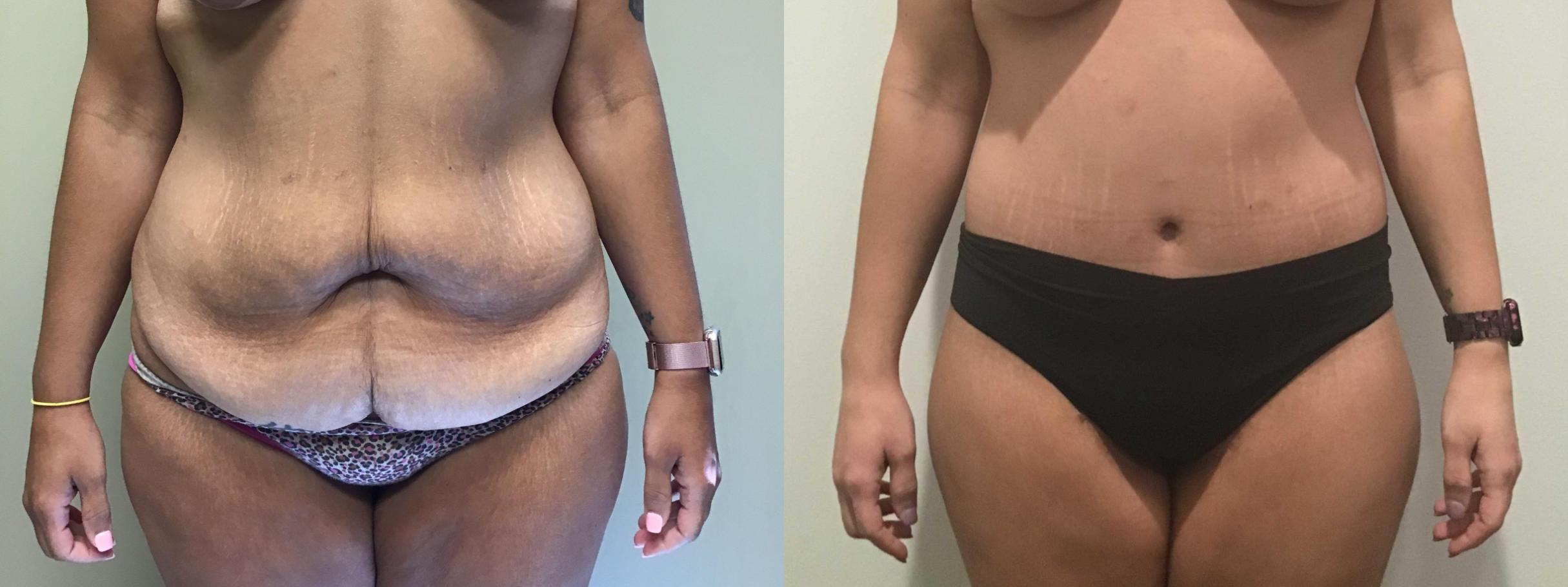 Body Contouring After Weight Loss Before and After Photo Gallery, Albany &  Latham, New York