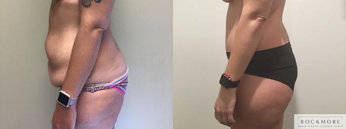 Before & After Body Contouring After Weight Loss Case 330 Left Side View in Albany & Latham, New York