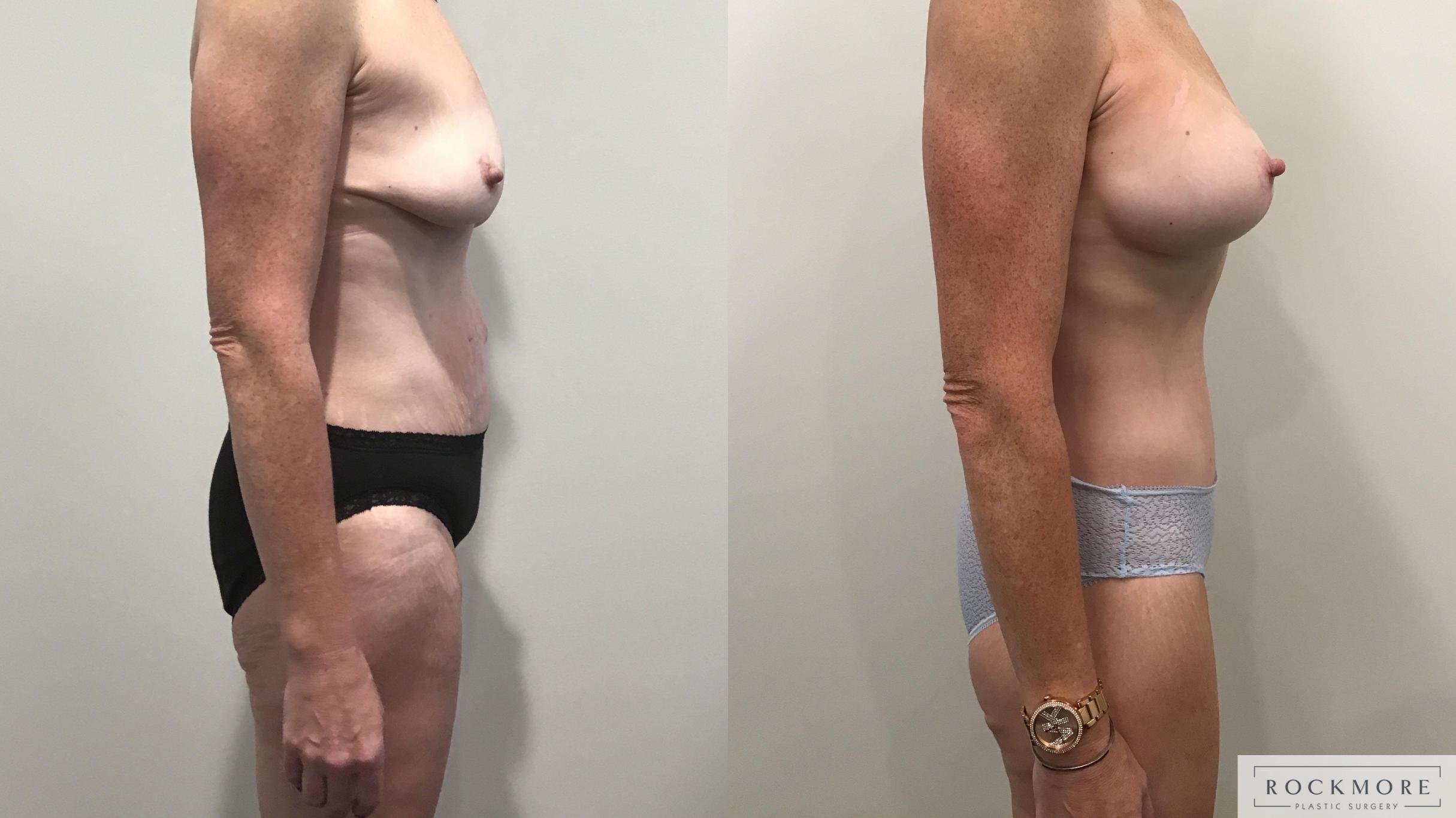 Before & After Body Contouring After Weight Loss Case 342 Right Side View in Albany & Latham, New York