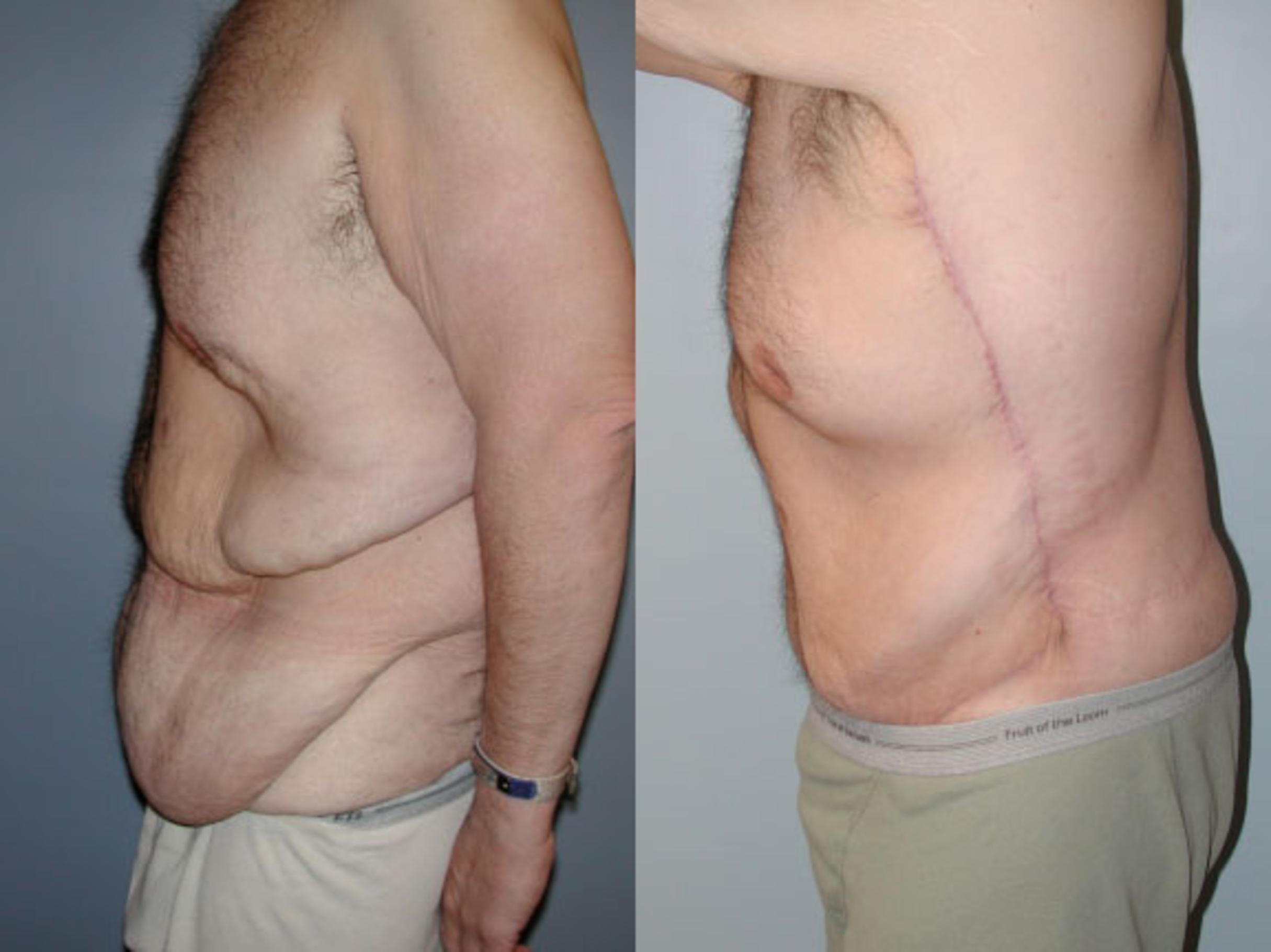 Before & After Body Contouring After Weight Loss Case 38 View #2 View in Albany, Latham & Saratoga, New York