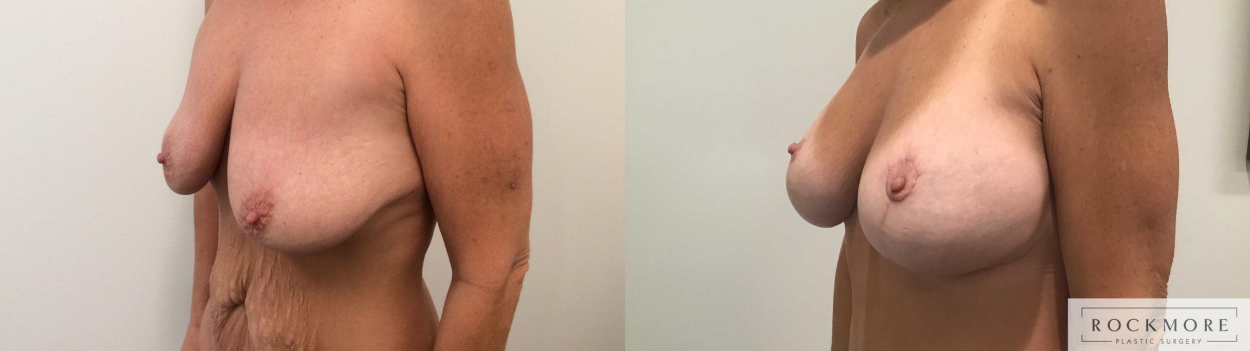 Before & After Body Contouring After Weight Loss Case 391 Left Oblique View in Albany & Latham, New York