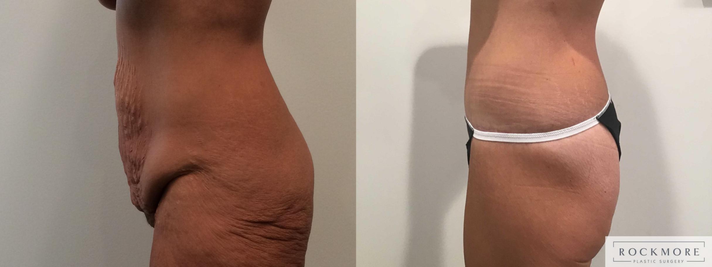 Before & After Body Contouring After Weight Loss Case 391 Right Side View in Albany & Latham, New York