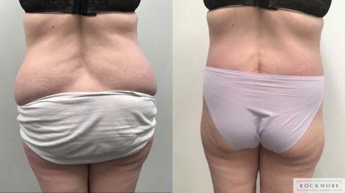 Before & After Body Contouring After Weight Loss Case 419 Back View in Albany & Latham, New York