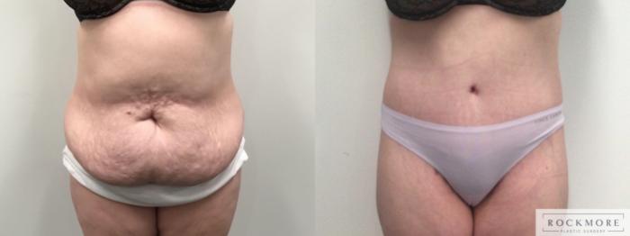 Before & After Body Contouring After Weight Loss Case 419 Front View in Albany & Latham, New York