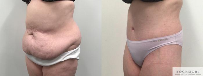 Before & After Body Contouring After Weight Loss Case 419 Left Side View in Albany & Latham, New York