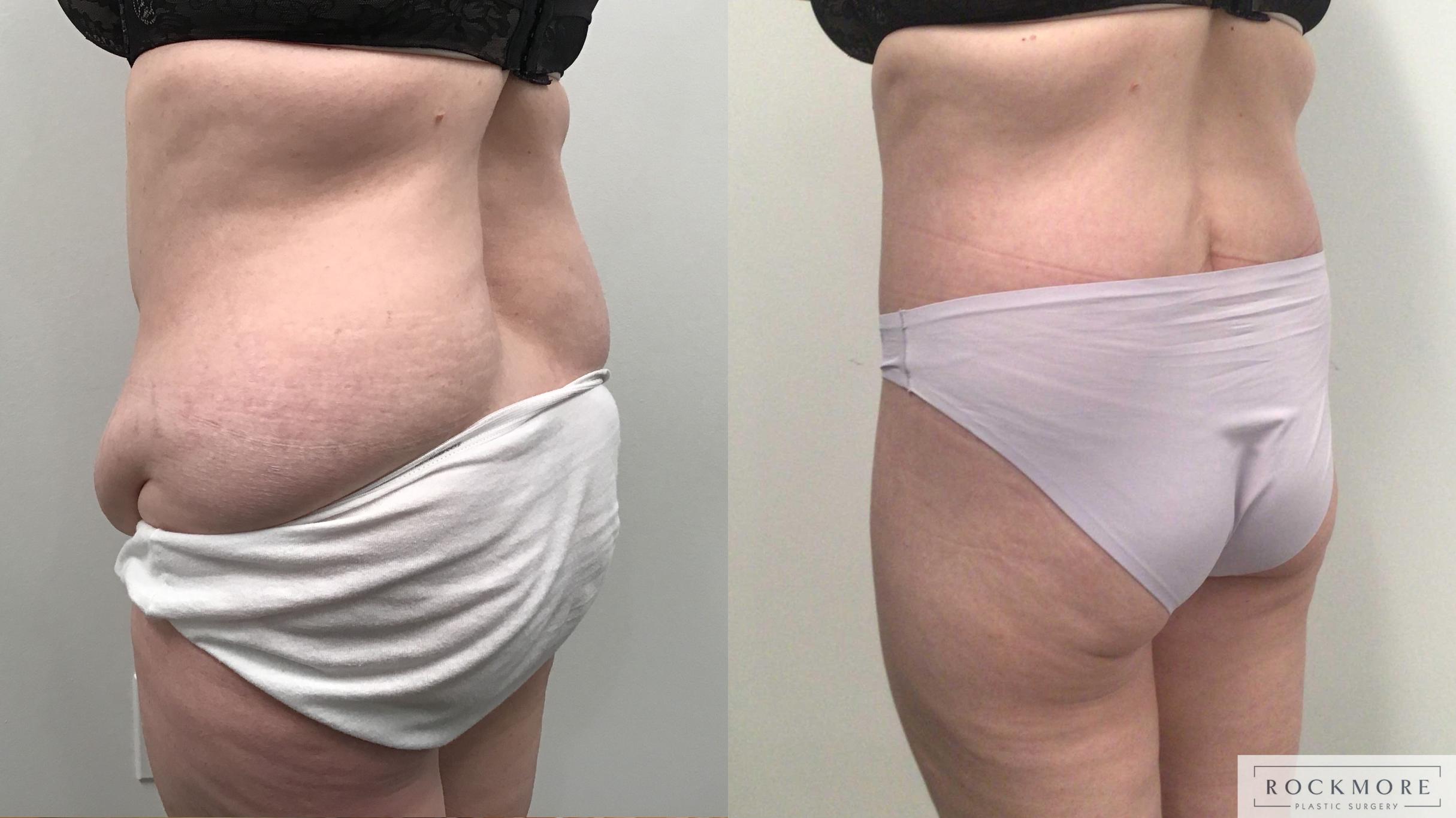 Before & After Body Contouring After Weight Loss Case 419 Right Oblique View in Albany & Latham, New York