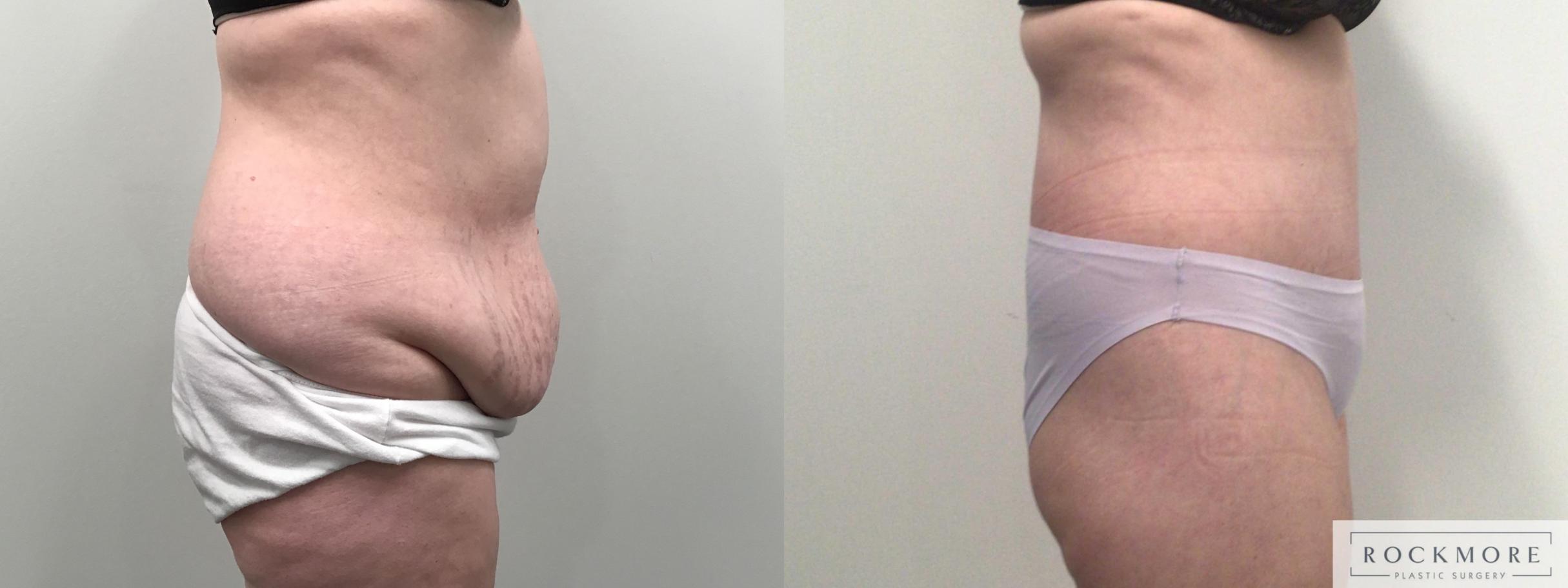 Before & After Body Contouring After Weight Loss Case 419 Right Side View in Albany & Latham, New York
