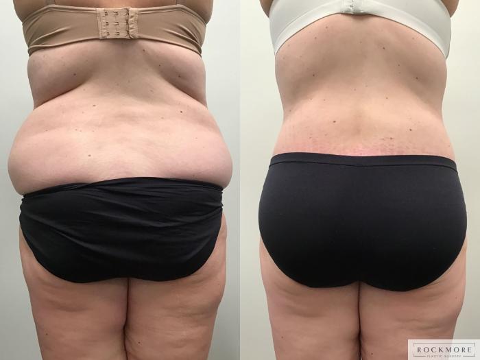 Body Contouring After Weight Loss Before and After Pictures Case 462, Albany & Latham, New York