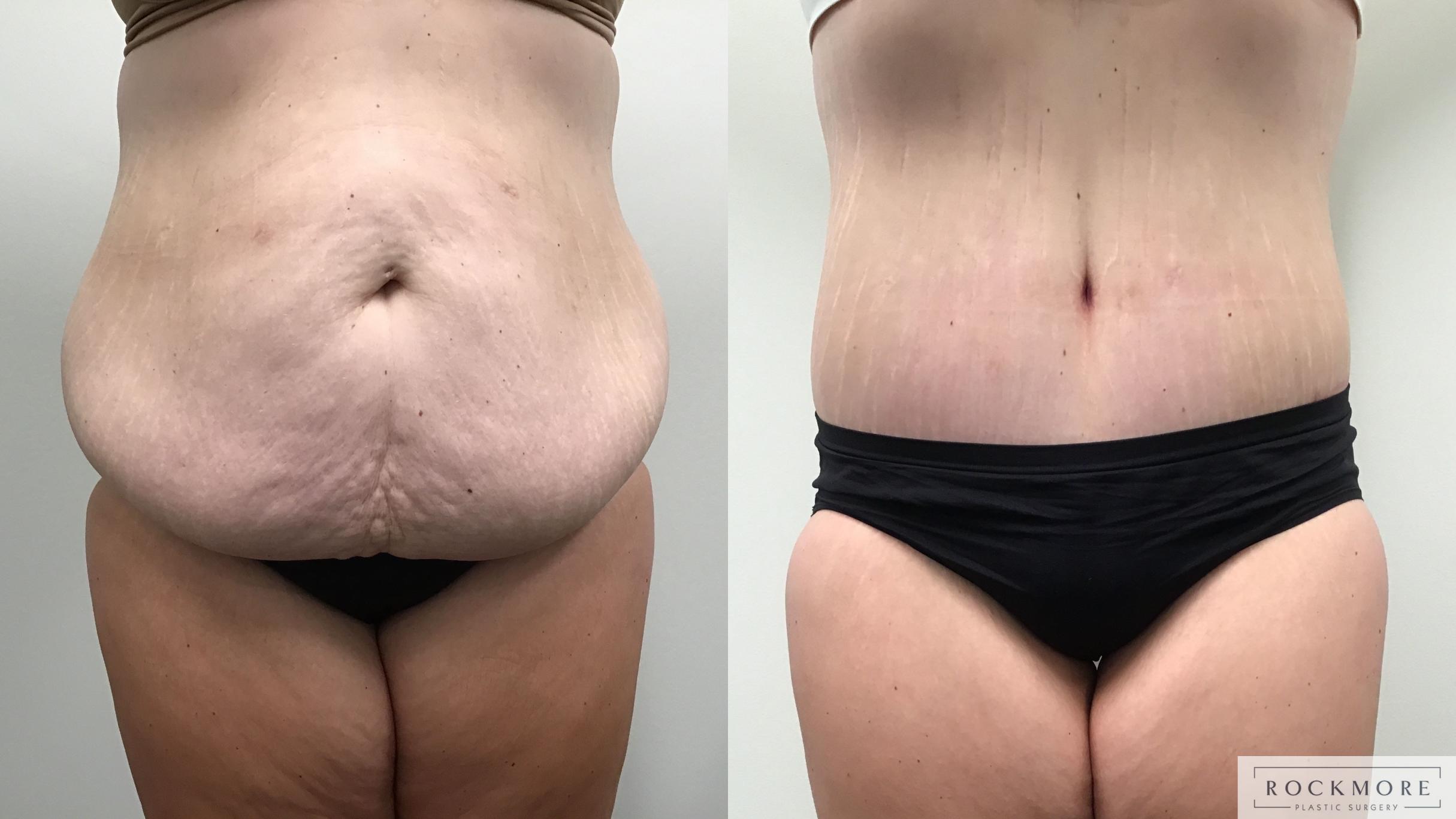 Before & After Body Contouring After Weight Loss Case 462 Front View in Albany & Latham, New York