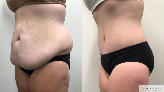 Before & After Body Contouring After Weight Loss Case 462 Left Side View in Albany & Latham, New York