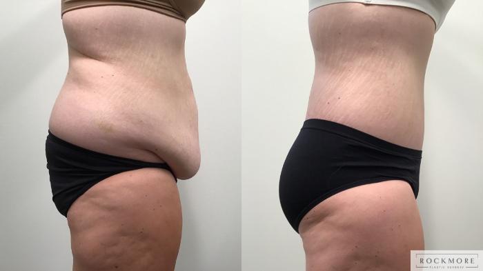 Before & After Body Contouring After Weight Loss Case 462 Right Side View in Albany & Latham, New York