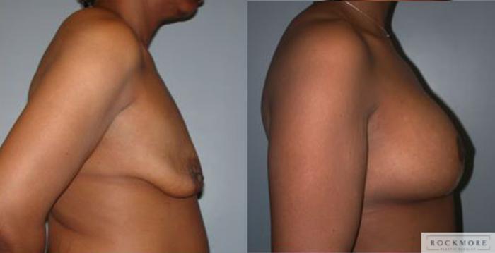 Before & After Body Contouring After Weight Loss Case 71 View #3 View in Albany & Latham, New York