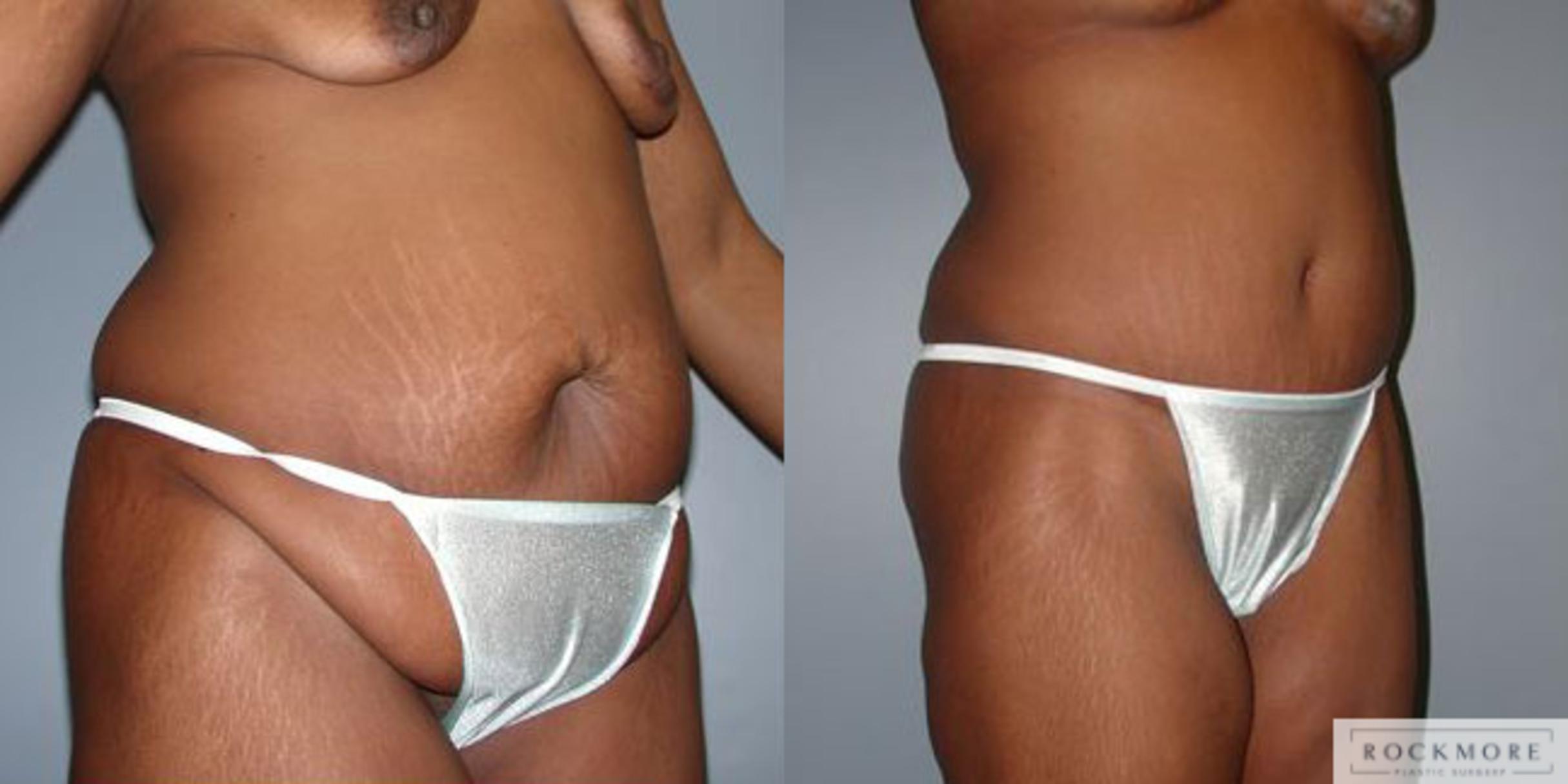 Before & After Body Contouring After Weight Loss Case 71 View #4 View in Albany & Latham, New York