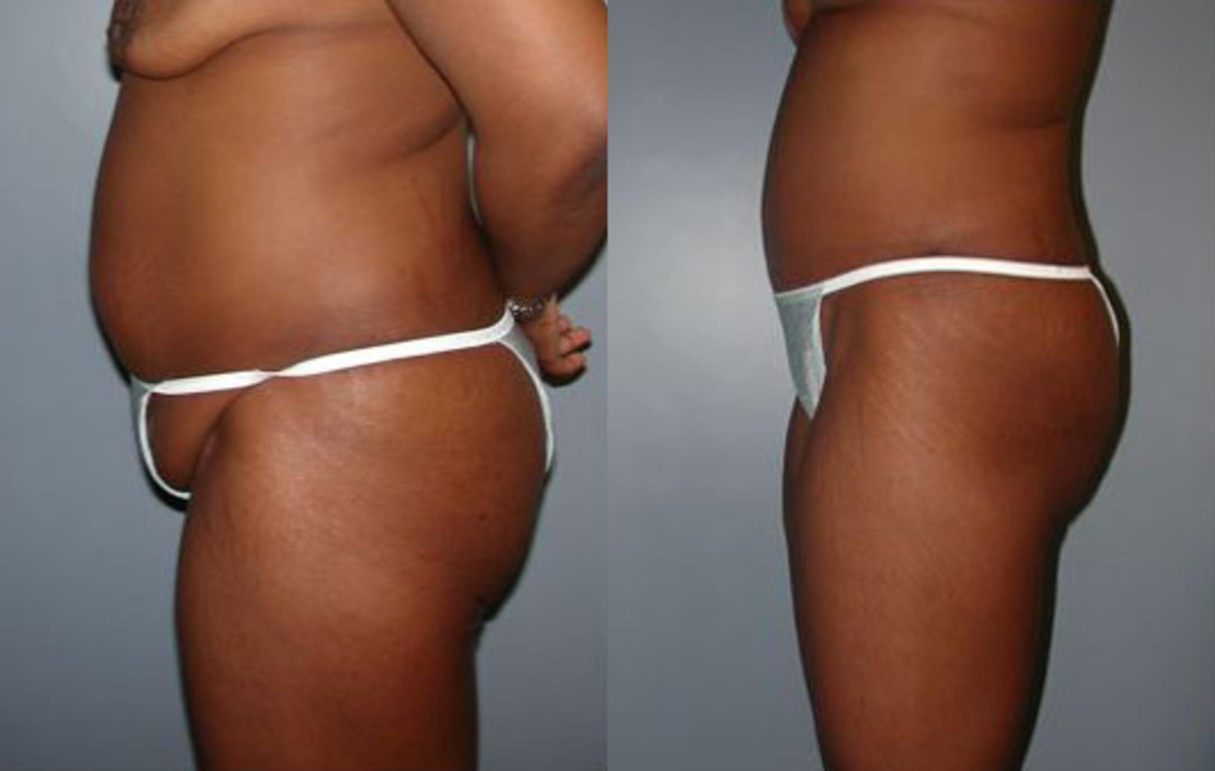 Before & After Body Contouring After Weight Loss Case 71 View #5 View in Albany, Latham & Saratoga, New York