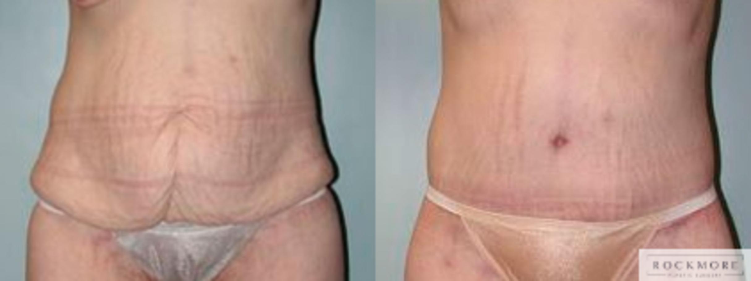 Before & After Body Contouring After Weight Loss Case 77 View #1 View in Albany & Latham, New York