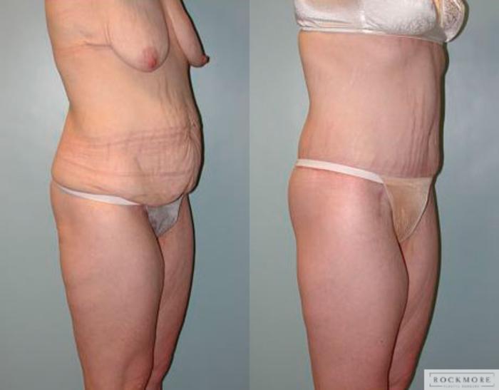 Before & After Body Contouring After Weight Loss Case 77 View #3 View in Albany & Latham, New York