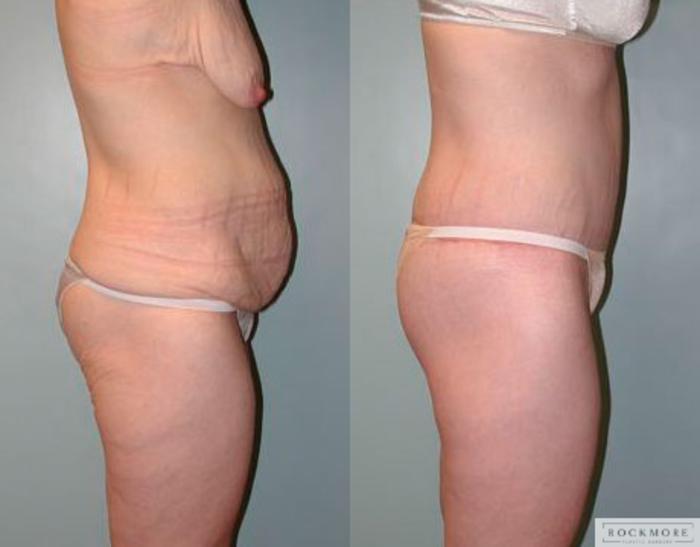 Before & After Body Contouring After Weight Loss Case 77 View #4 View in Albany & Latham, New York