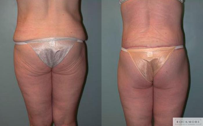 Before & After Body Contouring After Weight Loss Case 77 View #5 View in Albany & Latham, New York