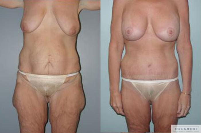 Before & After Body Contouring After Weight Loss Case 87 View #1 View in Albany & Latham, New York