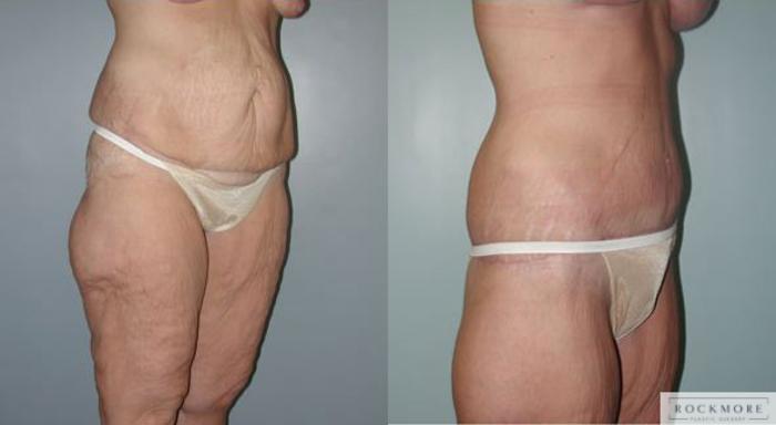 Before & After Body Contouring After Weight Loss Case 87 View #2 View in Albany & Latham, New York