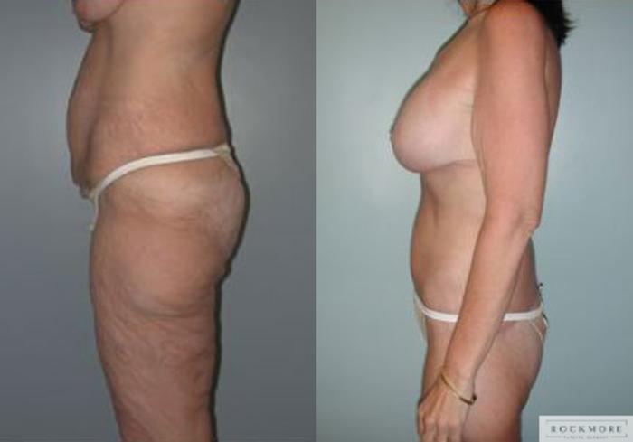 Before & After Body Contouring After Weight Loss Case 87 View #3 View in Albany & Latham, New York