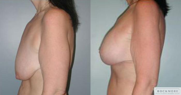 Before & After Body Contouring After Weight Loss Case 87 View #4 View in Albany & Latham, New York