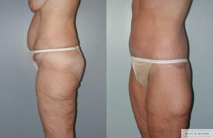 Before & After Body Contouring After Weight Loss Case 87 View #5 View in Albany & Latham, New York