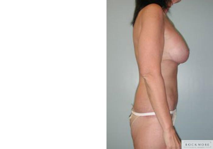 Before & After Body Contouring After Weight Loss Case 87 View #7 View in Albany & Latham, New York