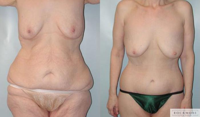 Before & After Body Contouring After Weight Loss Case 96 View #1 View in Albany & Latham, New York