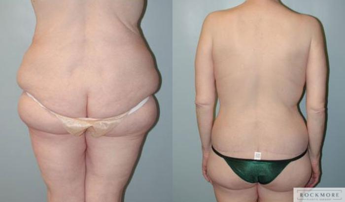 Before & After Body Contouring After Weight Loss Case 96 View #2 View in Albany & Latham, New York