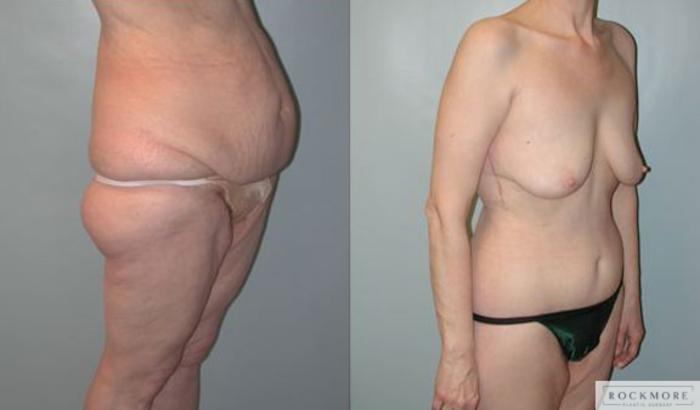 Before & After Body Contouring After Weight Loss Case 96 View #3 View in Albany & Latham, New York
