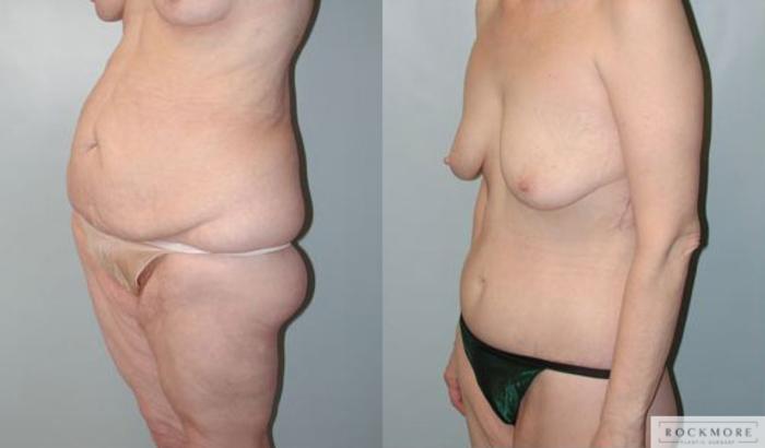 Before & After Body Contouring After Weight Loss Case 96 View #4 View in Albany & Latham, New York