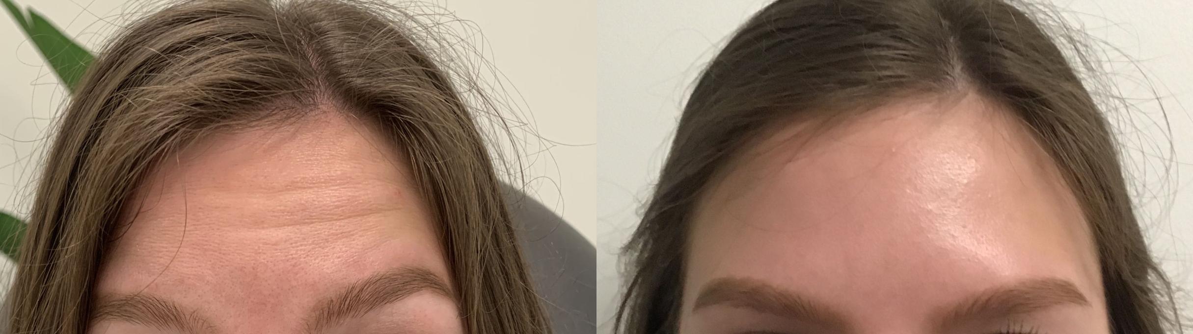 Before & After BOTOX® Cosmetic Case 333 Front View in Albany, Latham & Saratoga, New York