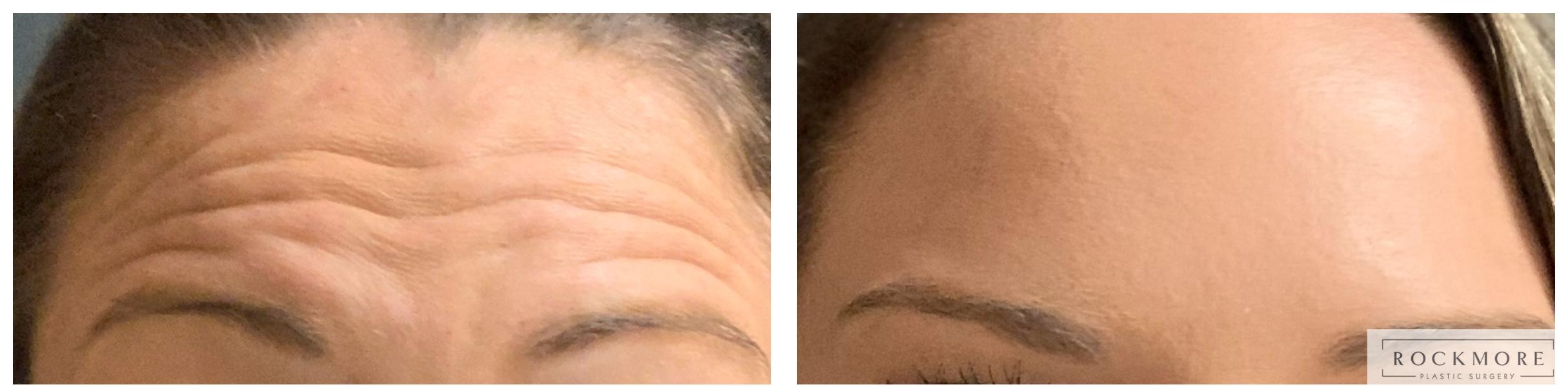 Before & After BOTOX® Cosmetic Case 336 Front View in Albany & Latham, New York