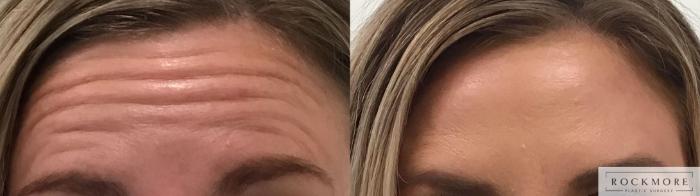 Before & After BOTOX® Cosmetic Case 339 Front View in Albany & Latham, New York