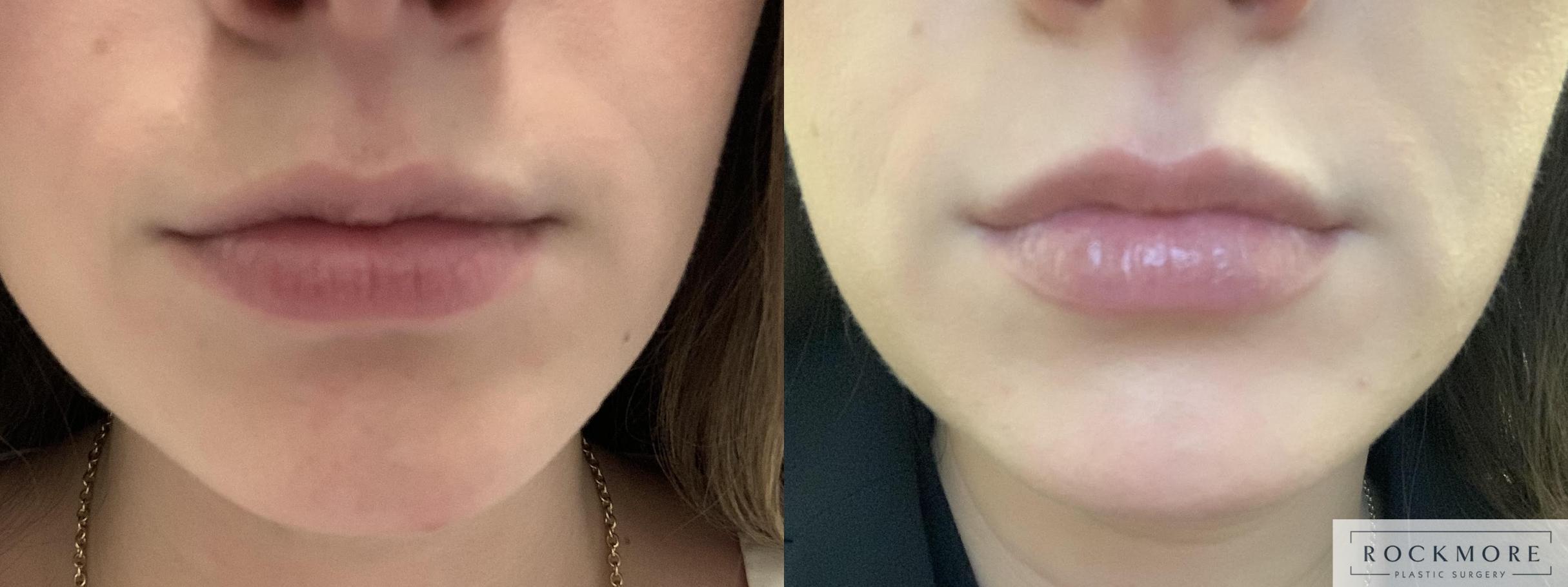 Before & After Lip Augmentation Case 384 Front View in Albany & Latham, New York