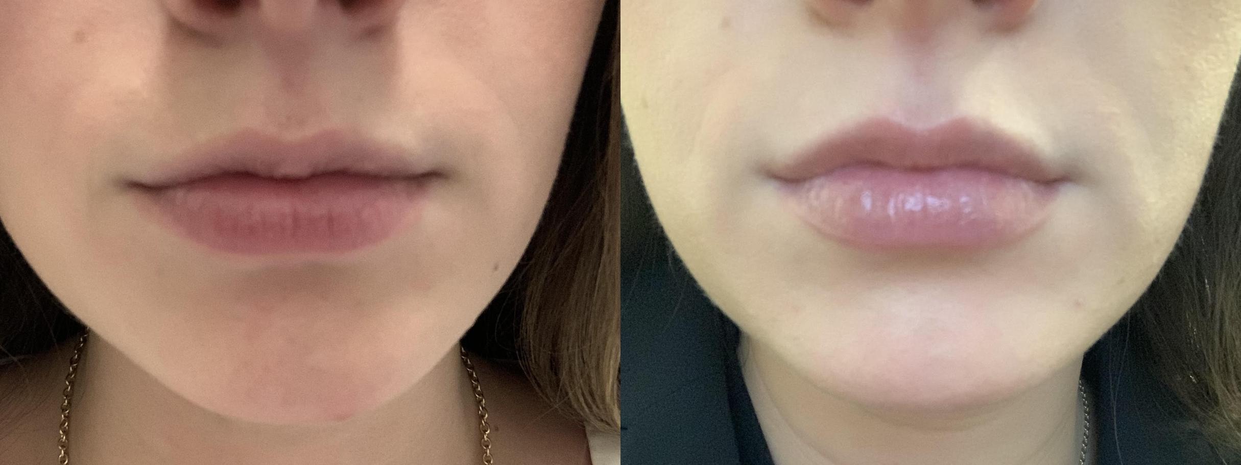 Before & After Lip Augmentation Case 384 Front View in Albany, Latham & Saratoga, New York