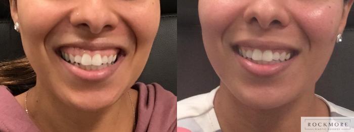 Before & After BOTOX® Cosmetic Case 386 Front View in Albany & Latham, New York