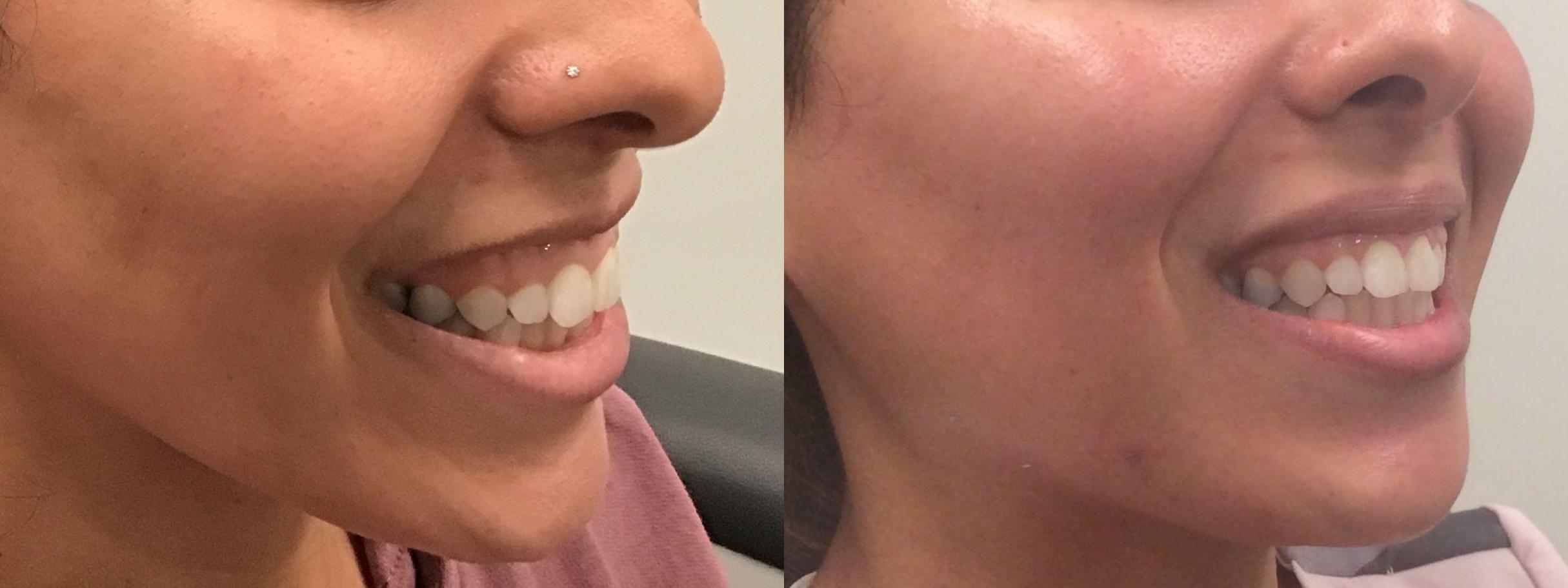 Before & After BOTOX® Cosmetic Case 386 Right Oblique View in Albany & Latham, New York