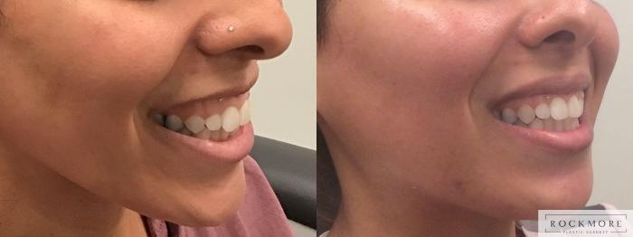 Before & After BOTOX® Cosmetic Case 386 Right Oblique View in Albany & Latham, New York