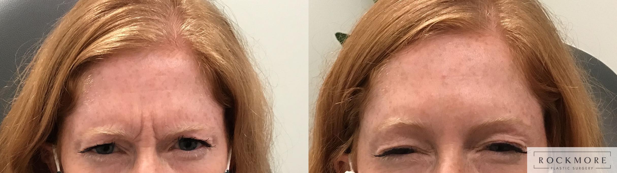 Before & After BOTOX® Cosmetic Case 387 Front View in Albany & Latham, New York