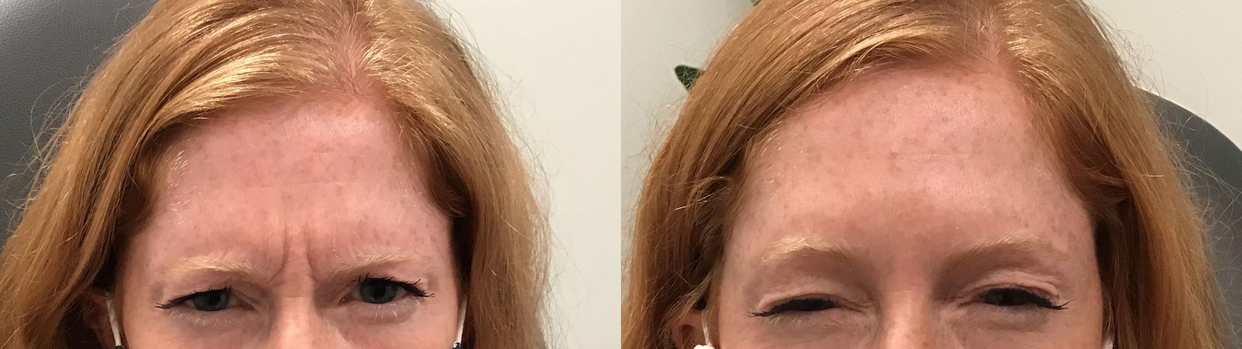 Before & After BOTOX® Cosmetic Case 387 Front View in Albany & Latham, New York