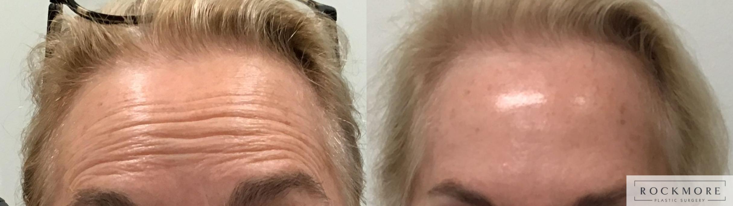 Before & After BOTOX® Cosmetic Case 409 Front View in Albany & Latham, New York