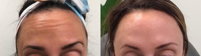 Before & After BOTOX® Cosmetic Case 416 Front View in Albany, Latham & Saratoga, New York