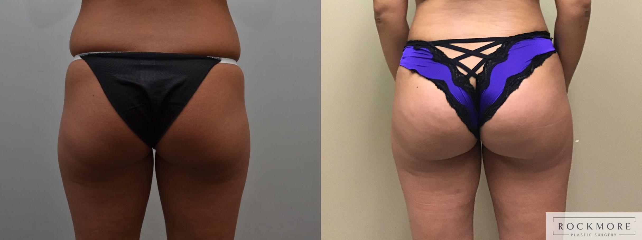 Before & After Brazilian Butt Lift Case 369 Back View in Albany & Latham, New York