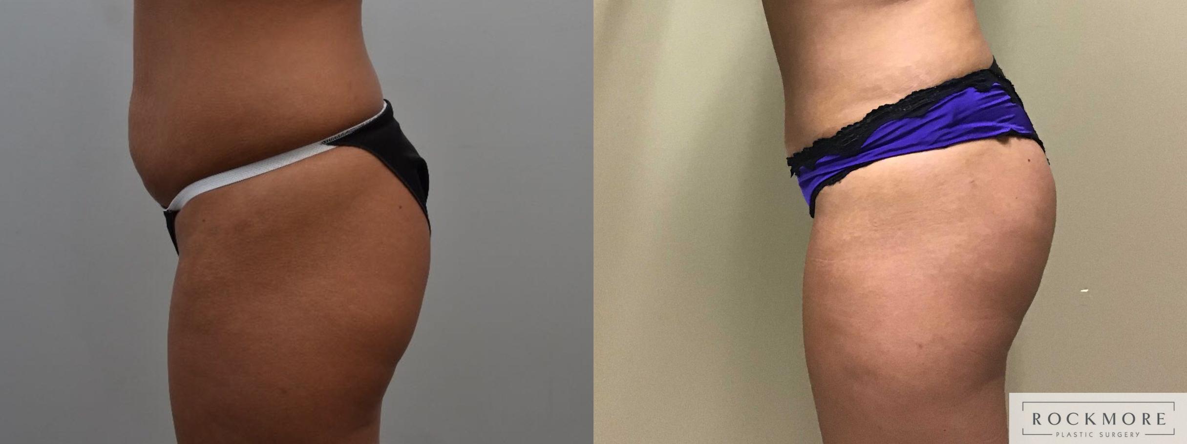 Before & After Brazilian Butt Lift Case 369 Left Side View in Albany & Latham, New York