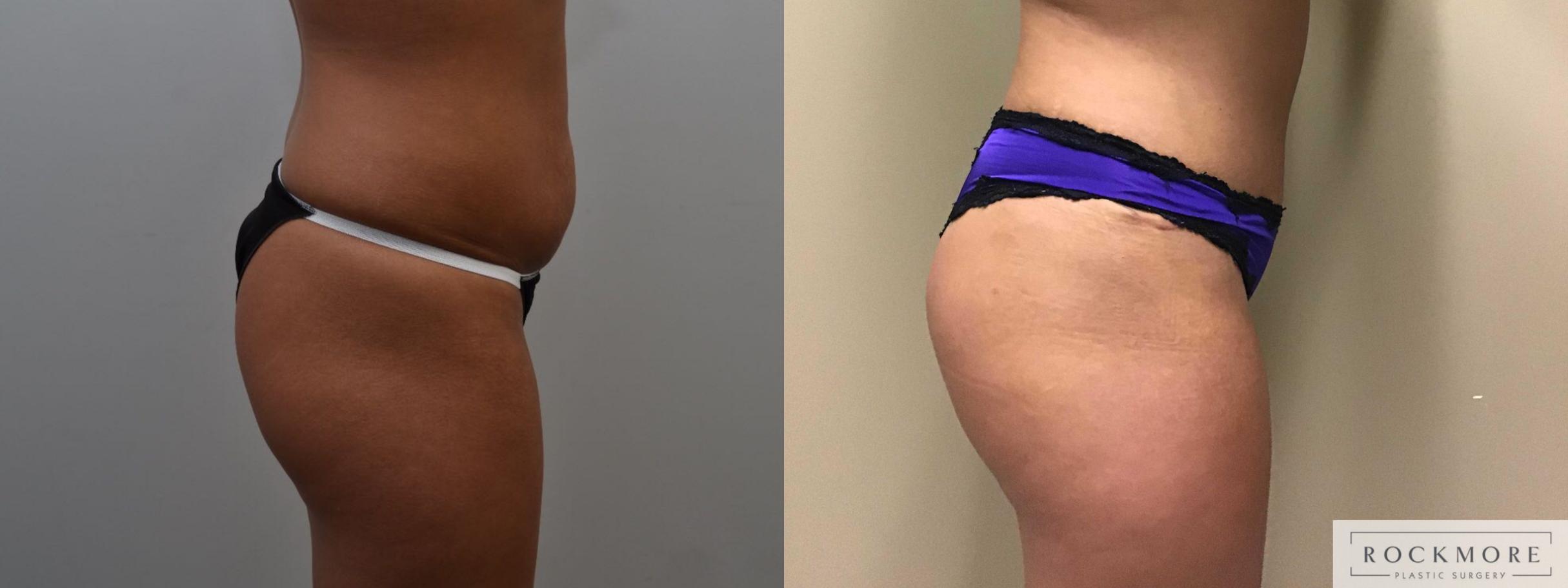 Before & After Brazilian Butt Lift Case 369 Right Side View in Albany & Latham, New York