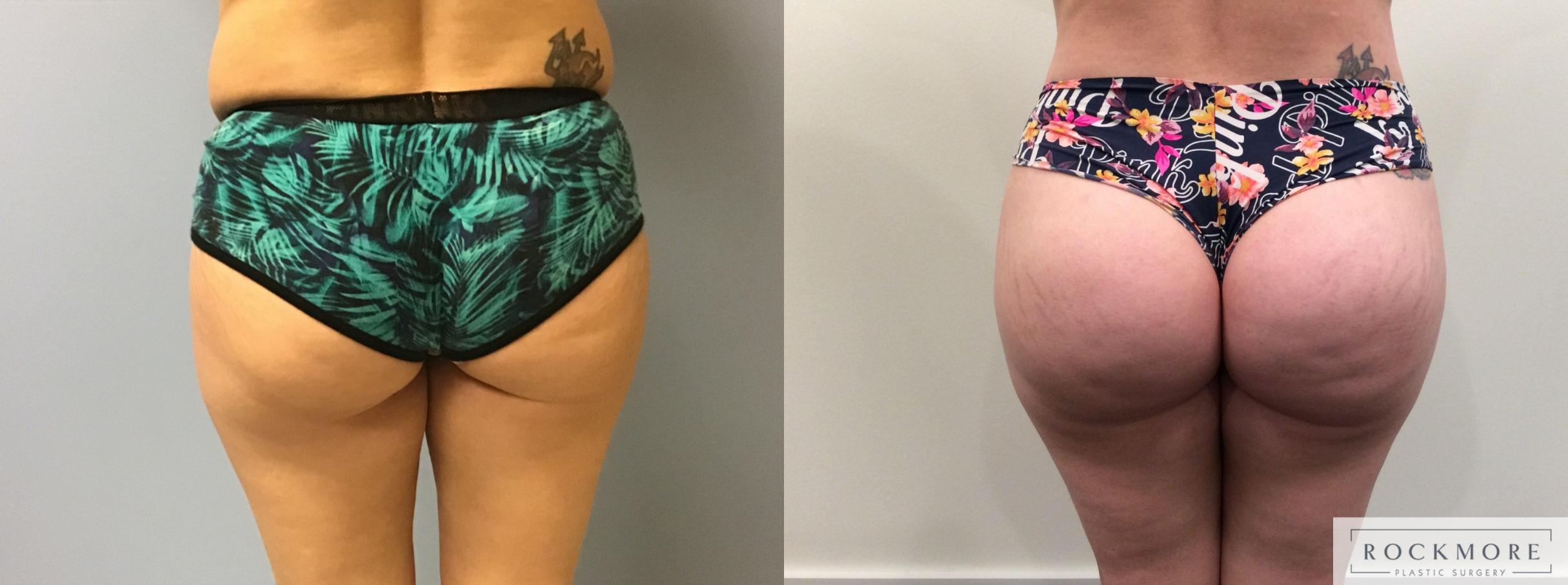 Before & After Brazilian Butt Lift Case 375 Back View in Albany & Latham, New York